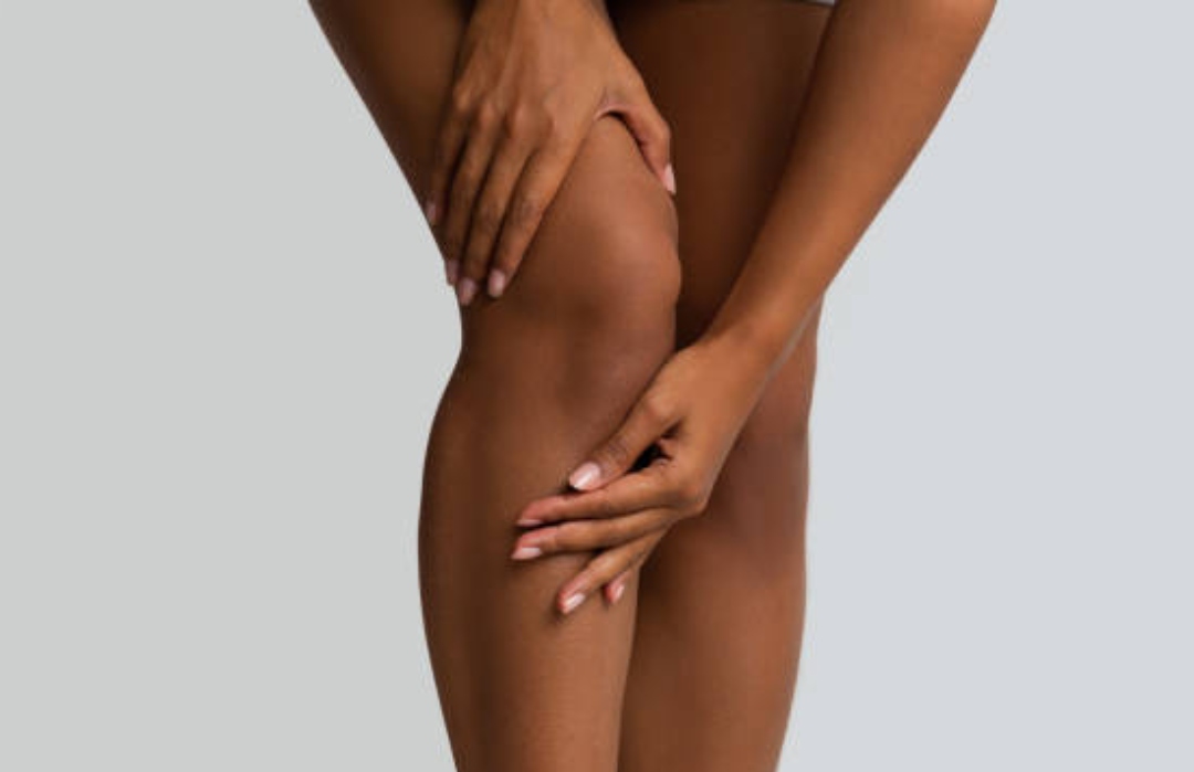 Dark Spots Women's Thighs